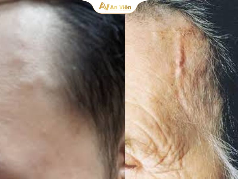Nổi Gân Trên Thái Dương