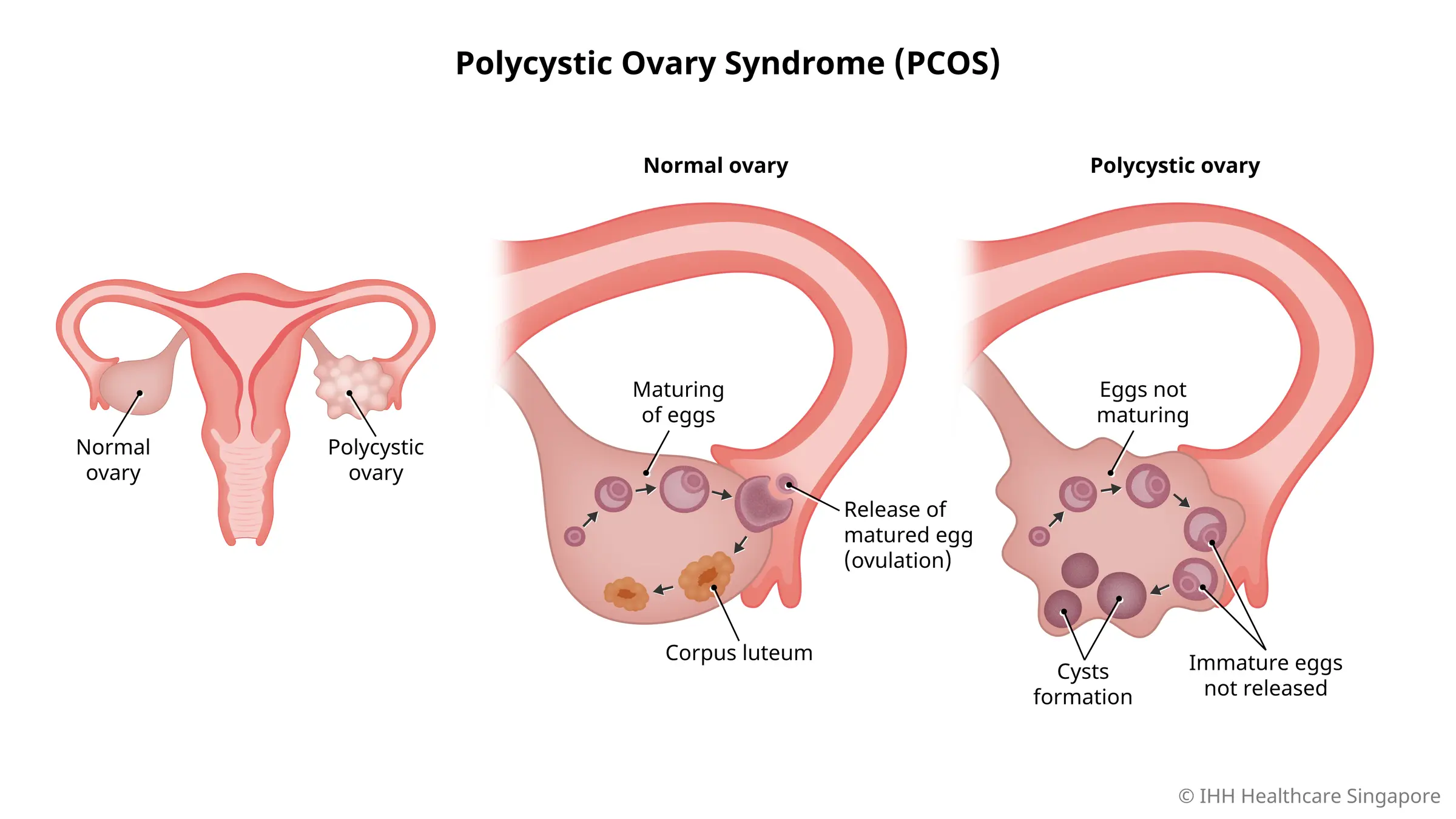 Pcos Là Bệnh Gì