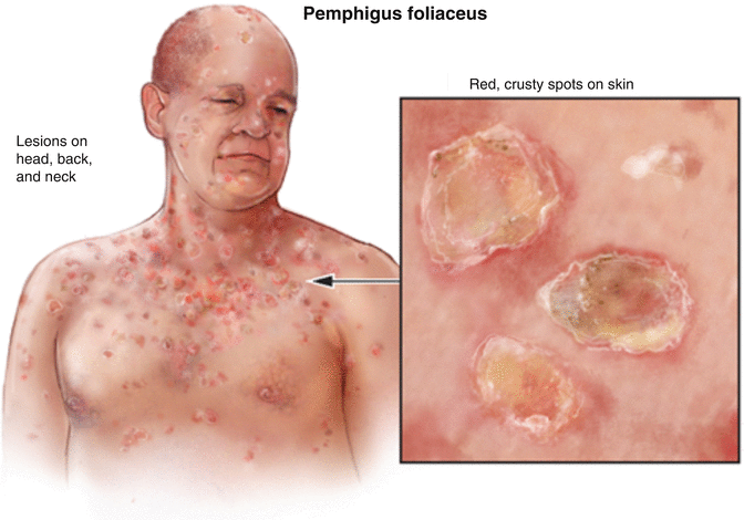 Pemphigus Là Gì