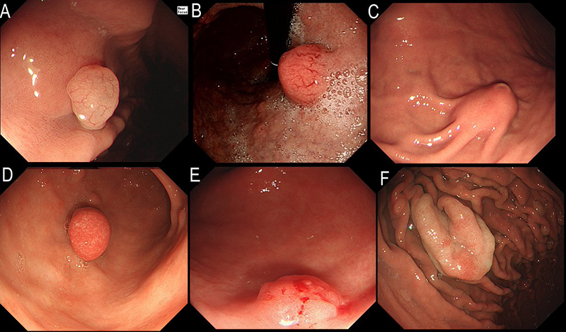 Polyp Thân Vị Là Gì