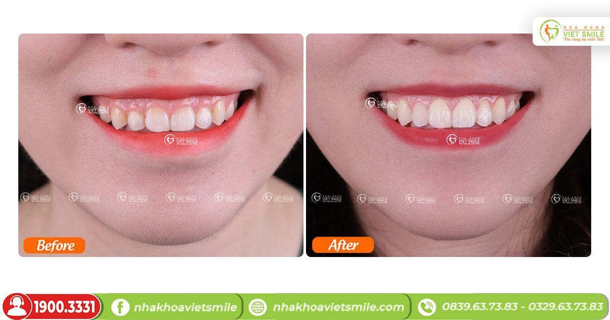 Review Cắt Lợi