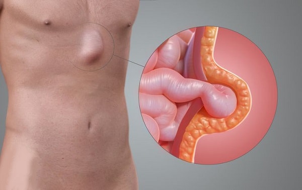 Rốn Lồi ở Người Lớn