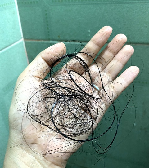 Rụng Nhiều Tóc