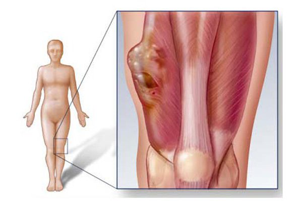Sarcoma Mô Mềm Sống được Bao Lâu