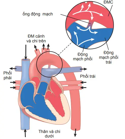 Shunt Trái Phải Là Gì