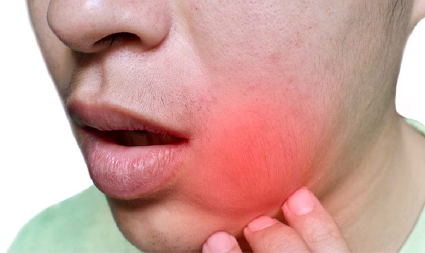 Sưng Nướu Răng Sưng Mặt
