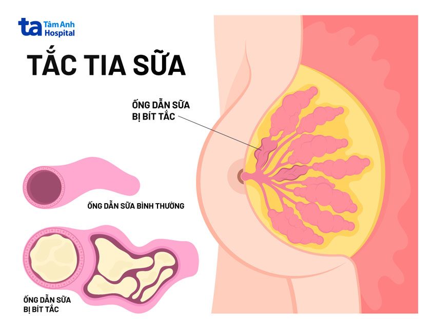 Tắc Sữa Sau Sinh