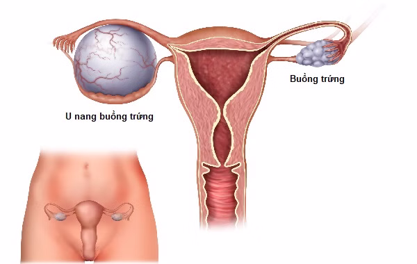 Tại Sao Bị U Nang Buồng Trứng