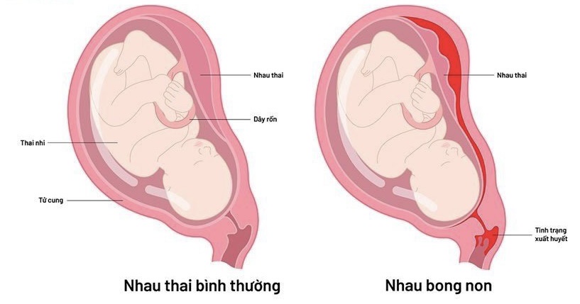 Thai Chết Lưu Là Gì