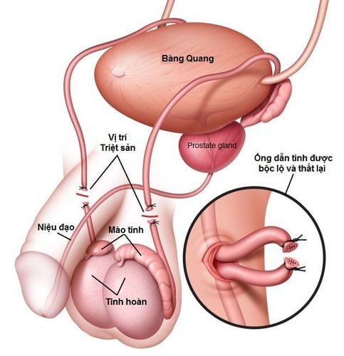 Thắt ống Dẫn Tinh Có đau Không