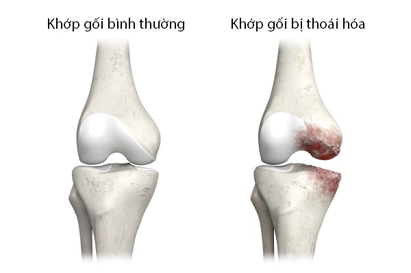 Thoái Hóa Xương