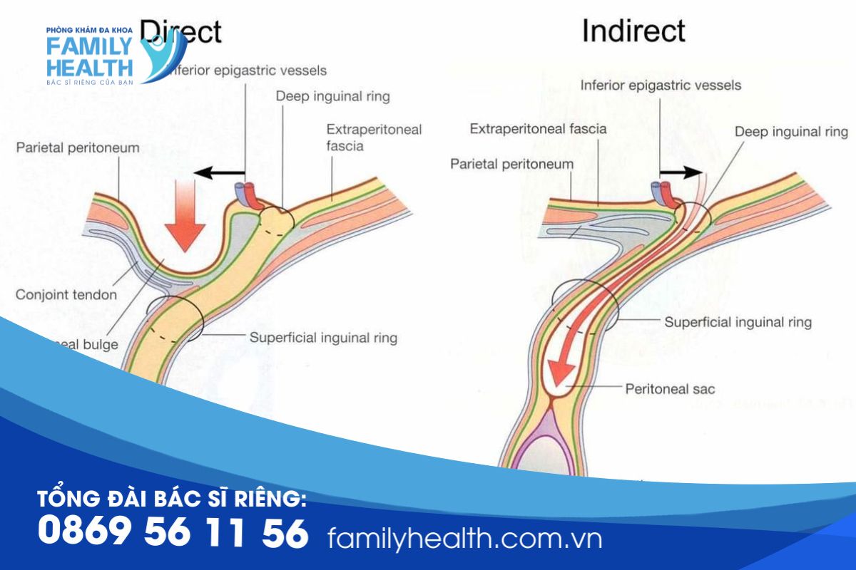 Thoát Vị Bẹn Gián Tiếp