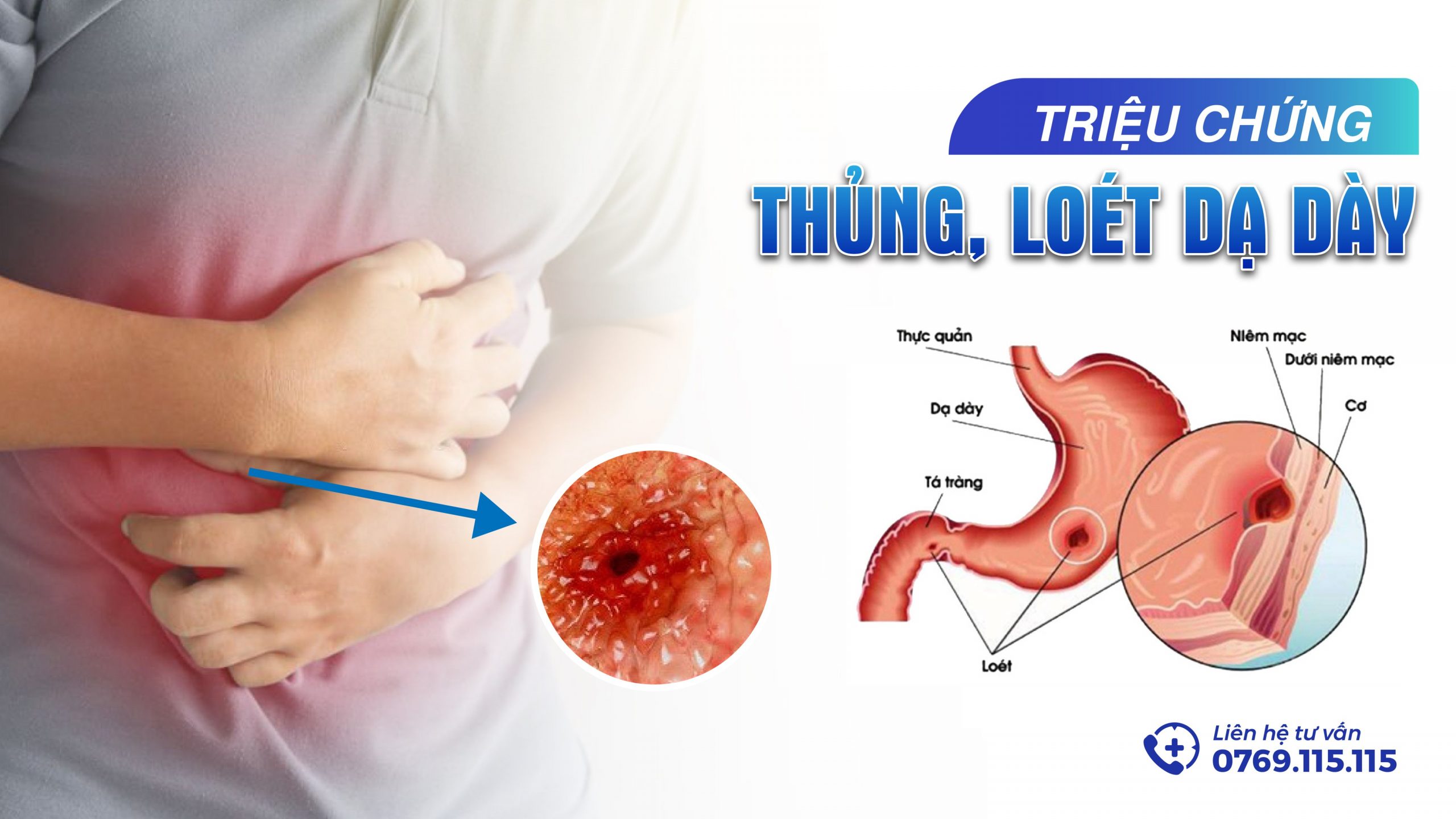Thủng Dạ Dày Tá Tràng