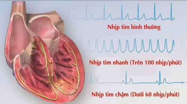 Tim đập Chậm Có Nguy Hiểm Không