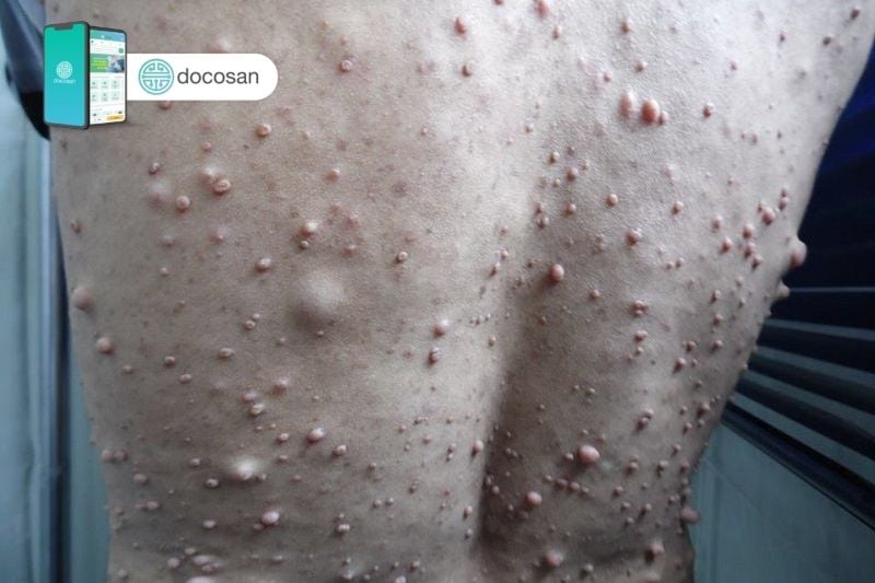 Tin Mới Về điều Trị Bệnh U Sợi Thần Kinh