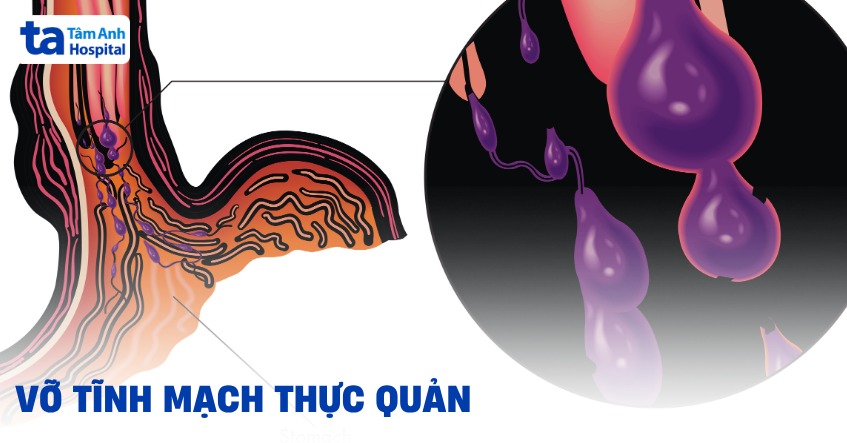 Tĩnh Mạch Thực Quản