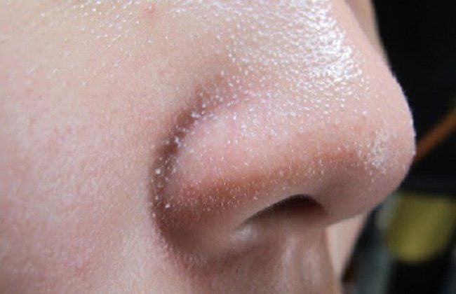 Trị Mụn đầu Trắng
