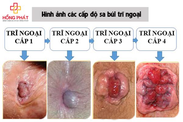 Triệu Chứng Bệnh Trĩ Ngoại