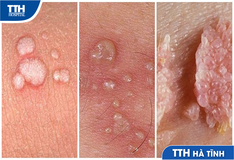 Triệu Chứng Của Bệnh Sùi Mào Gà
