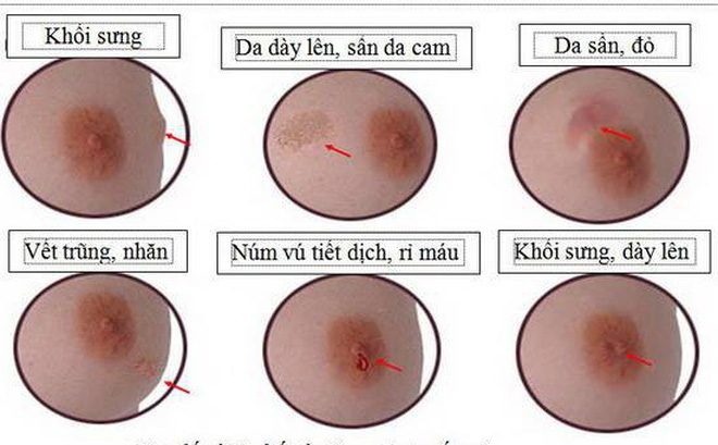 Triệu Chứng Ung Thu Vú