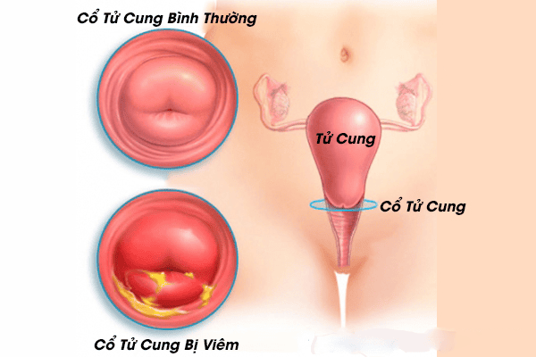 Triệu Chứng Viêm Cổ Tử Cung