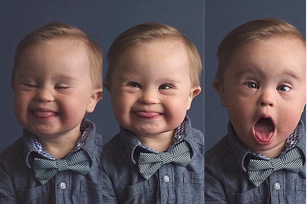 Trisomy 21 Là Gì