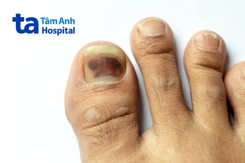 U Hắc Tố Dưới Móng