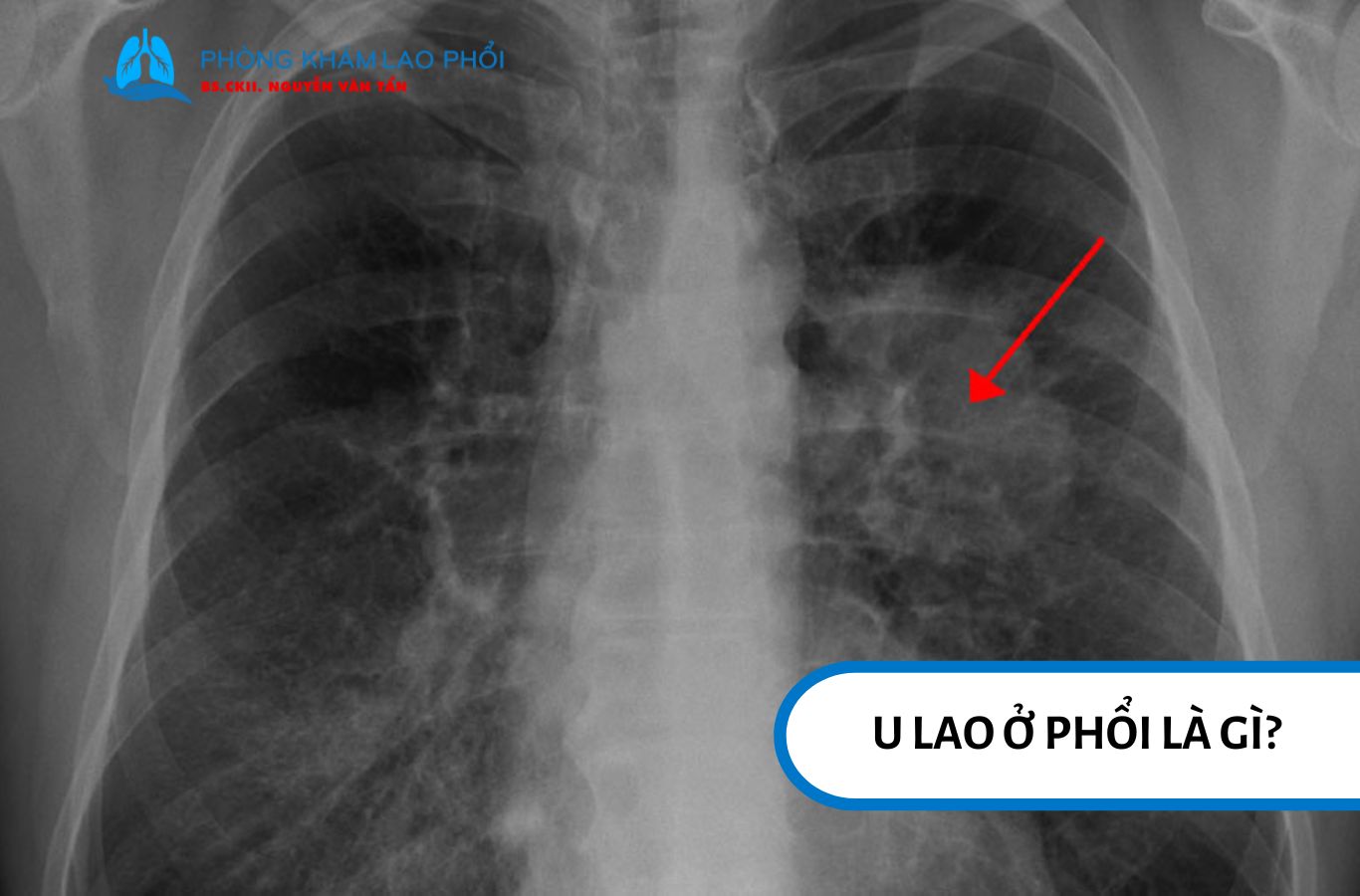 U Lao Phổi