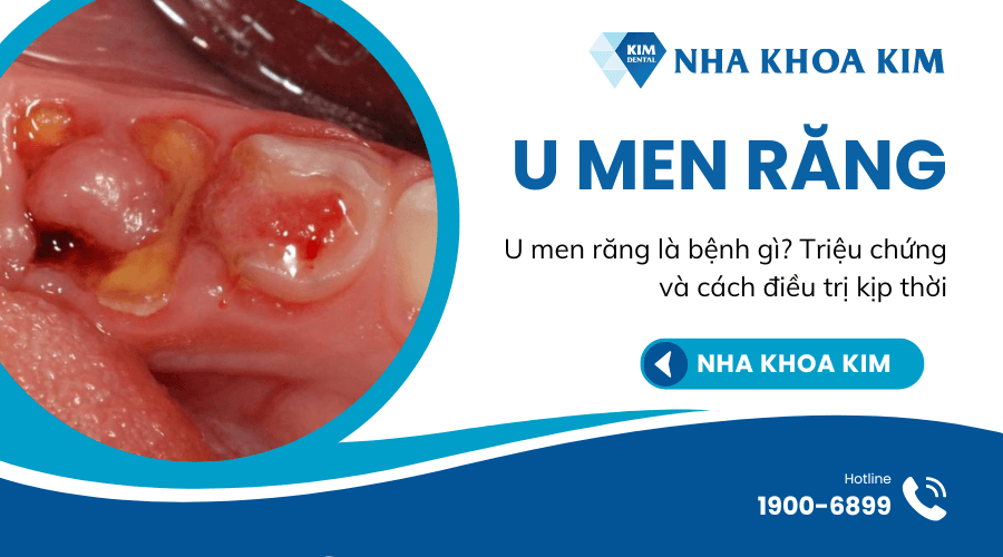 U Men Răng