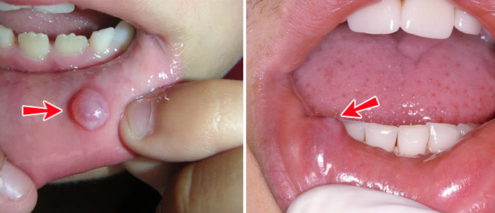 U Nhầy Môi Dưới