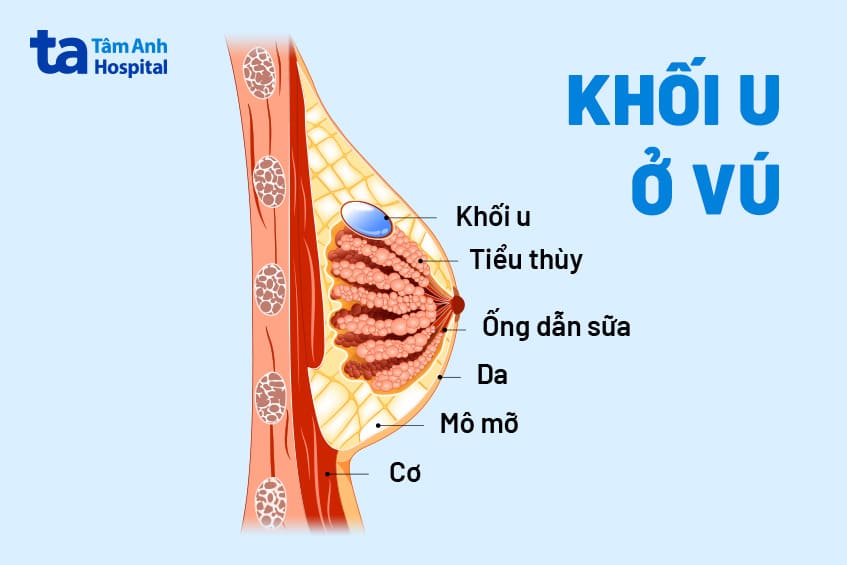 U ở Ngực
