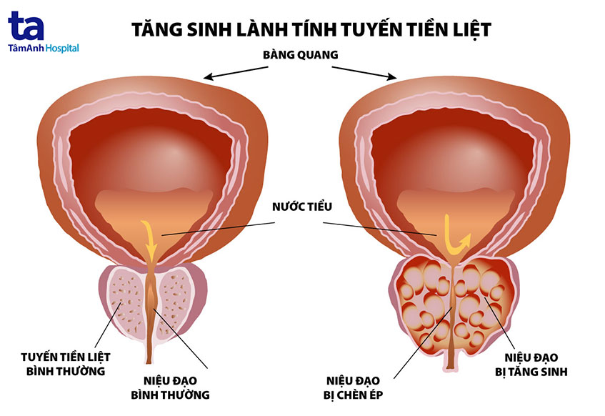 U Phì đại Tiền Liệt Tuyến