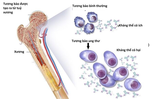 Ung Thư Tủy Xương