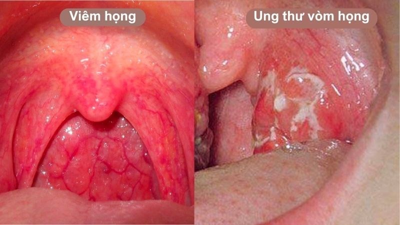 Ung Thư Vòm Họng Có Biểu Hiện Gì