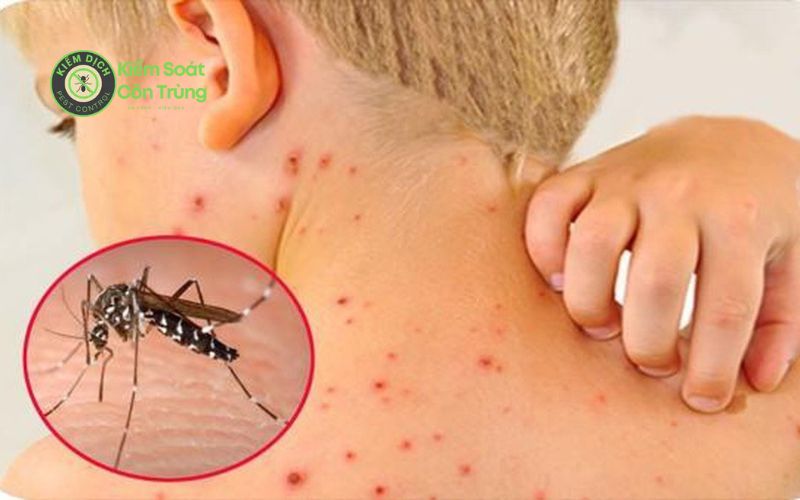 Vết Muỗi đốt Sốt Xuất Huyết