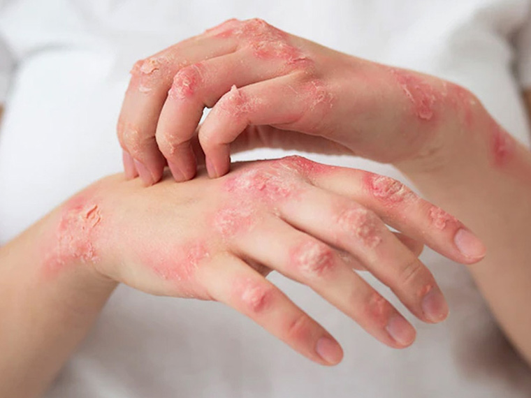 Viêm Da Cơ địa Tiếng Anh