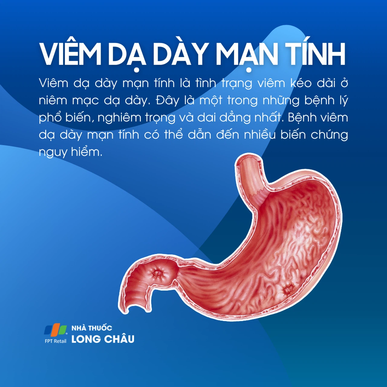 Viêm Dạ Dày Mãn Tính Là Gì