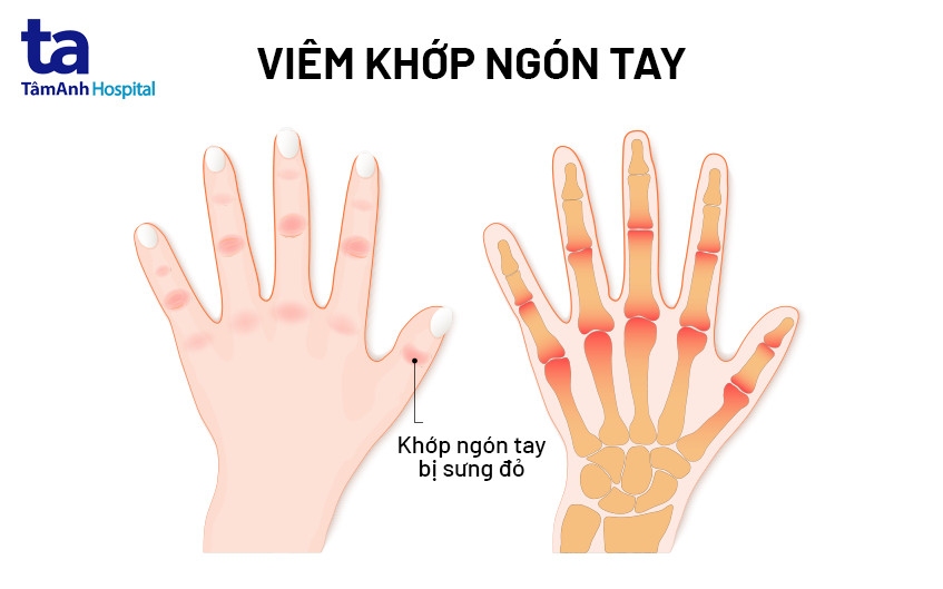 Viêm Khớp Tay