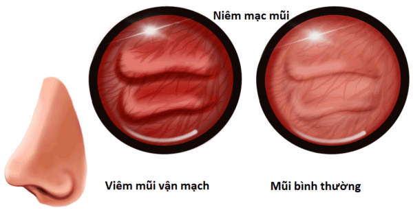 Viêm Mũi Vận Mạch Là Gì