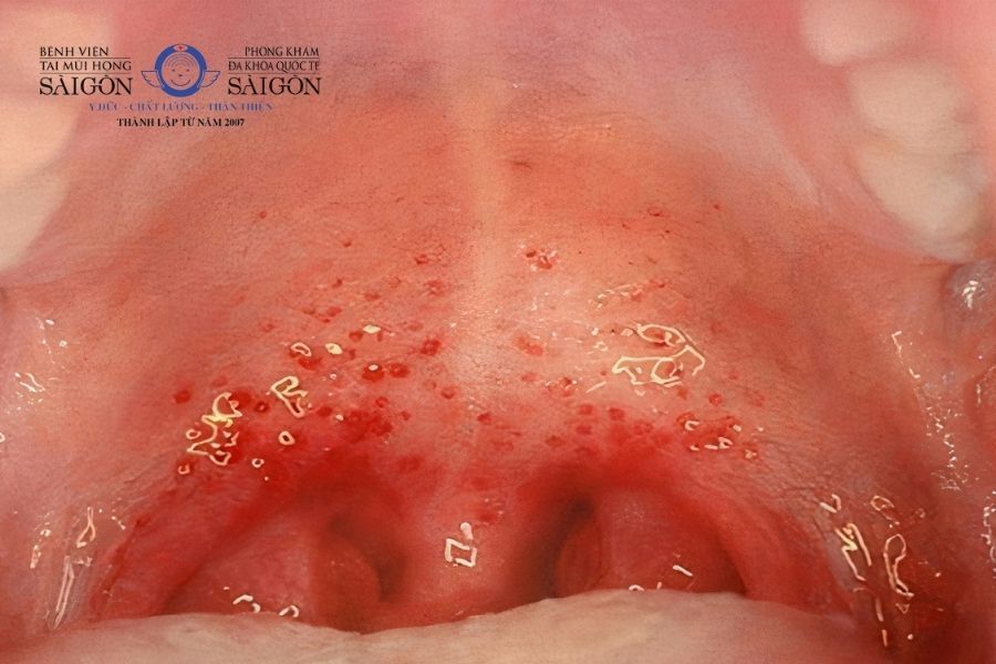 Viêm Thanh Quản Bao Lâu Thì Khỏi