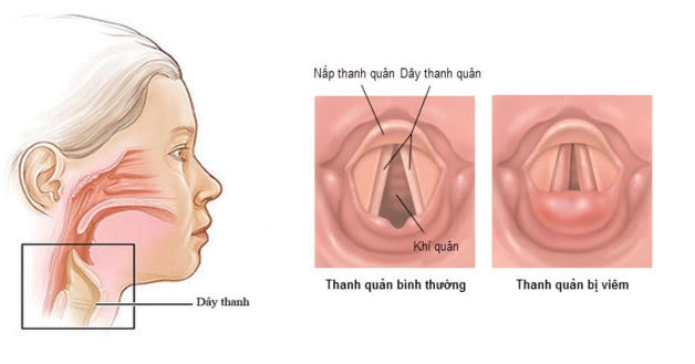 Viêm Thanh Quản Uống Thuốc Gì