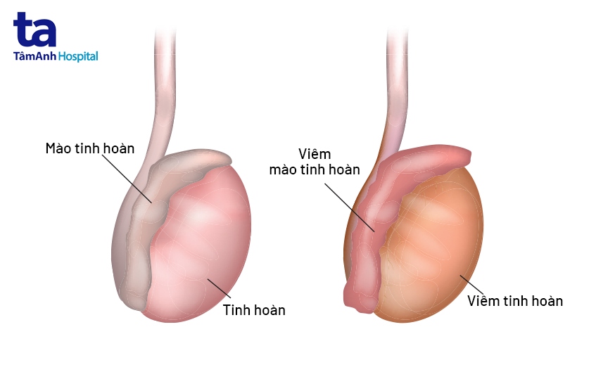 Viem Tinh Hoan
