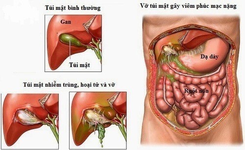 Viêm Túi Mật Có Nguy Hiểm Không