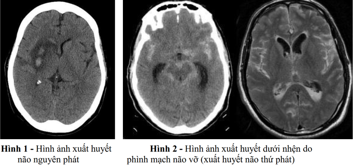 Xuất Huyết Não Ct