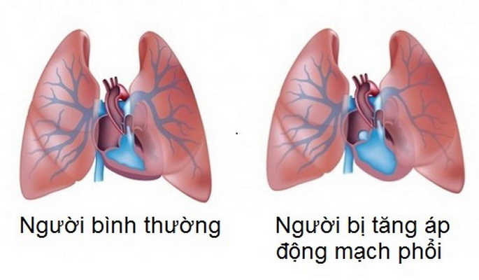 áp Lực đông Mạch Phổi Bình Thường