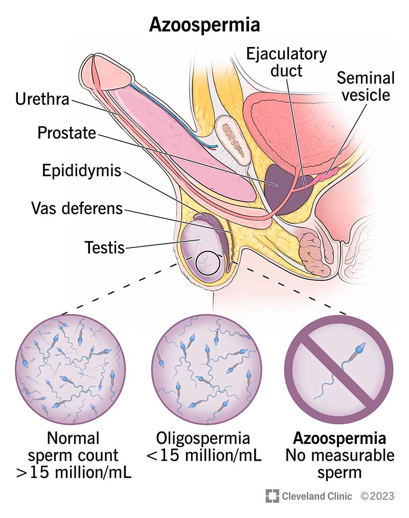 Azoospermia Là Gì