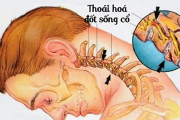 Bệnh Thoái Hóa Cột Sống Cổ