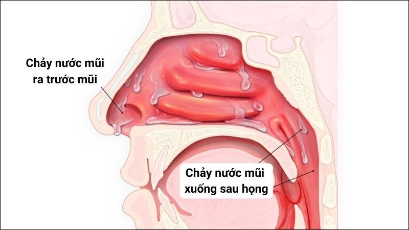 Bị Chảy Nước Mũi