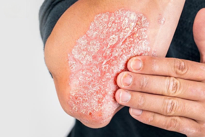 Bị Vảy Nến Là Gì