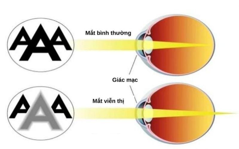 Bị Viễn Thị Là Gì